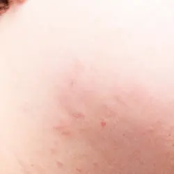 Imagen de picadura de chinches